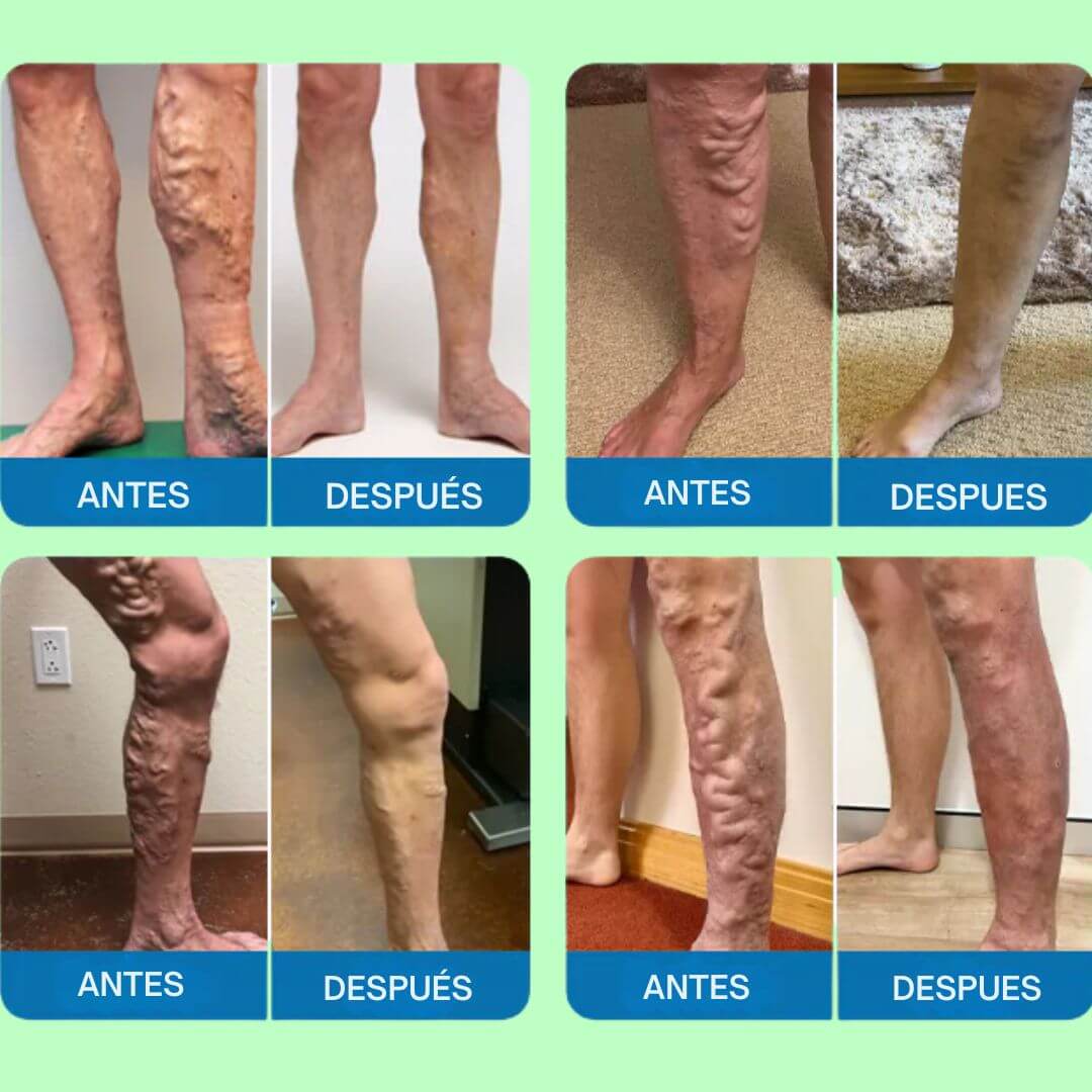 VARICOSE VEINS X120 ml Adiós a las Varices