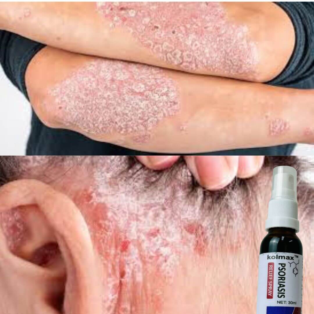 KOLMAX™ Spray Para Psoriasis X2
