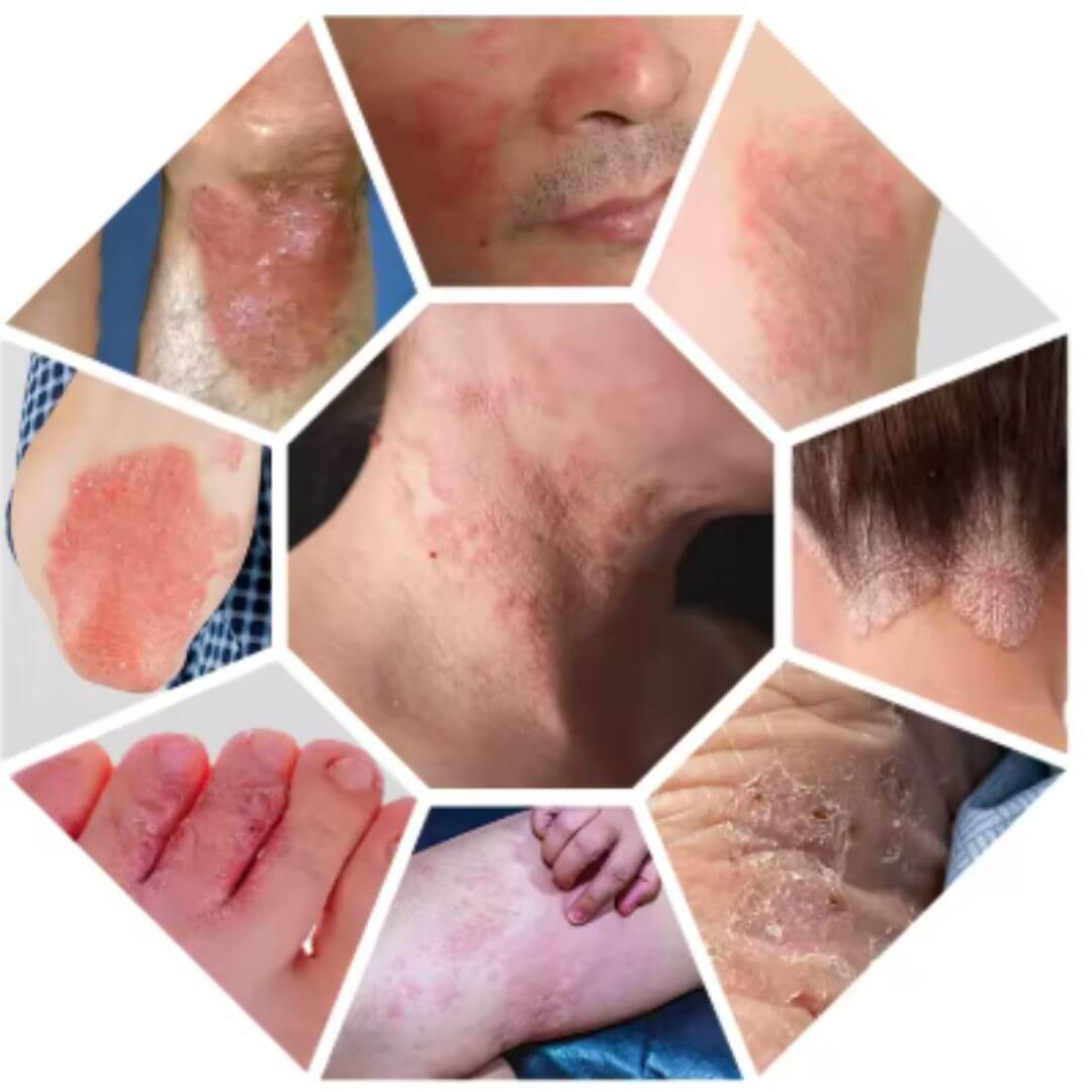 KOLMAX™ Spray Para Psoriasis X2