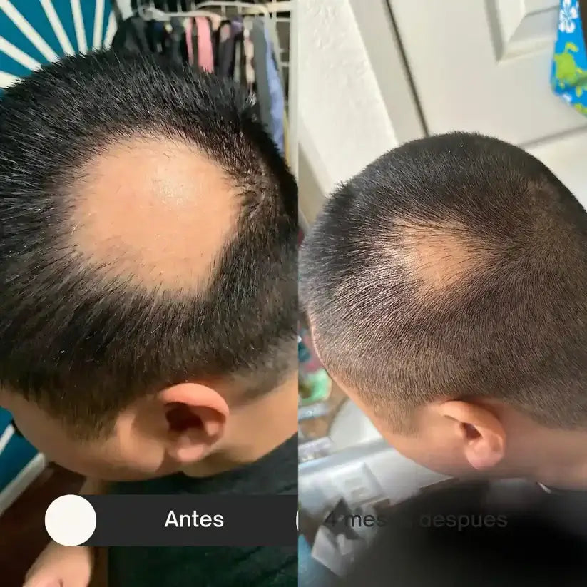 ScalpFit Pro – Estimulador Capilar Eléctrico + E-book